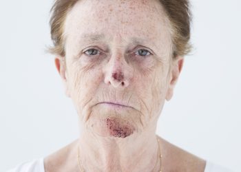 I Just Slipped (TW: Domestic Abuse)